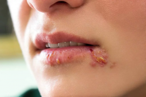 Penyebab Penyakit Herpes
