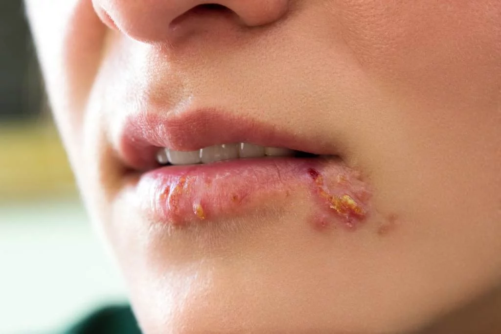 Penyebab Penyakit Herpes